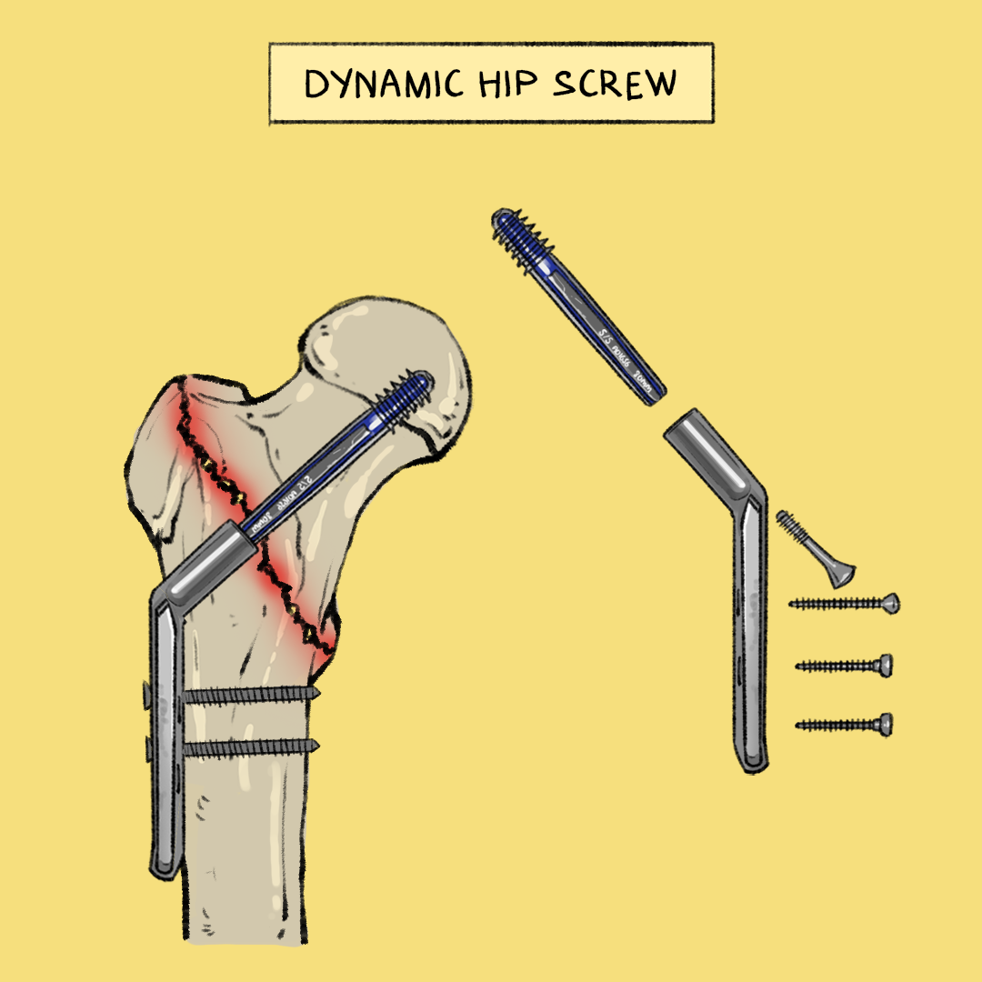 Intertrochanteric Fractures Management And Considerations With PPT 
